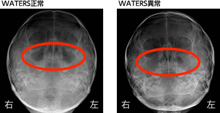 外耳炎